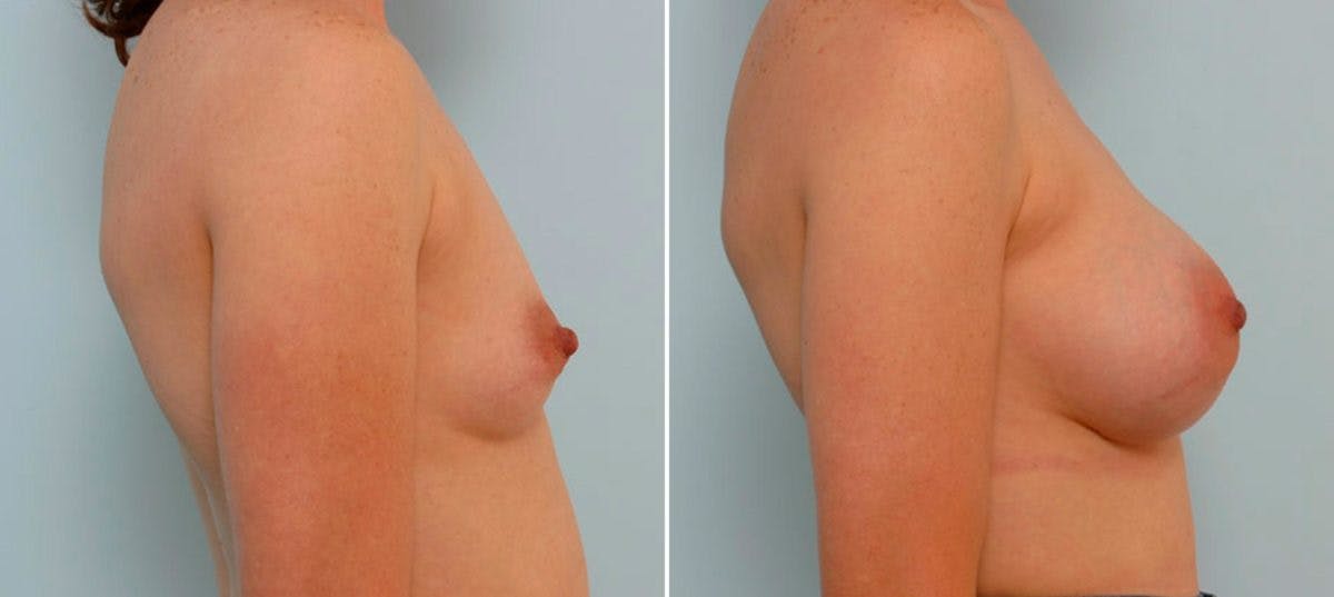 Breast Augmentation Before & After Gallery - Patient 54886766 - Image 3