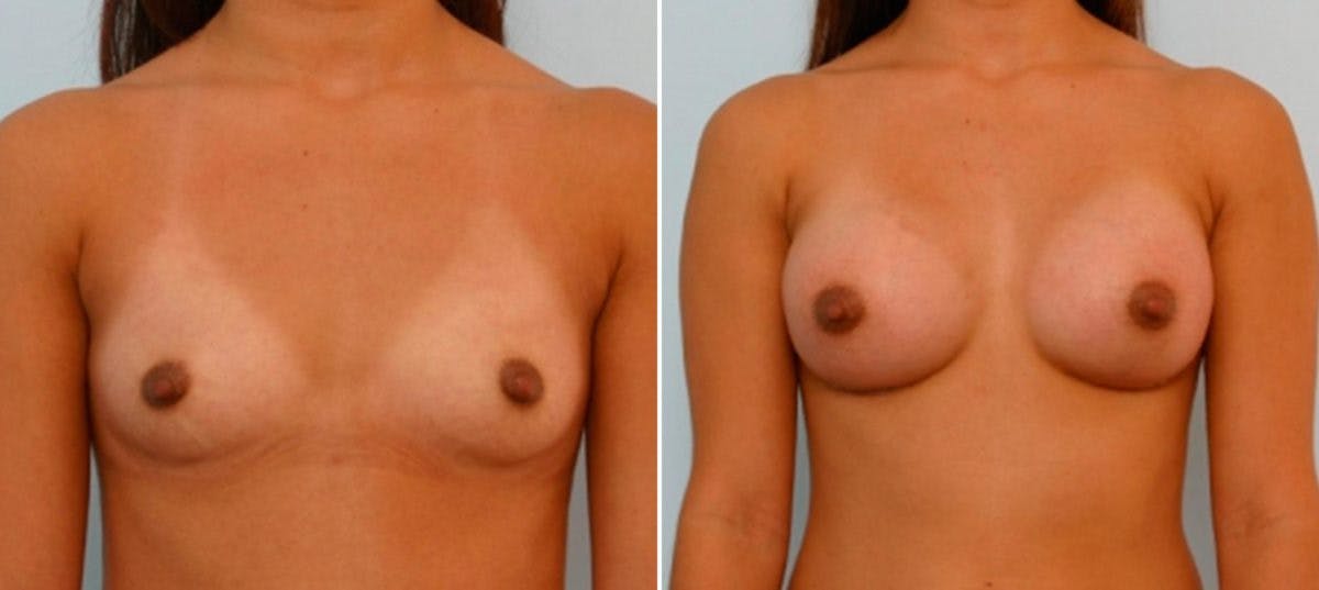 Breast Augmentation Before & After Photo - Patient 54886769 - Image 1