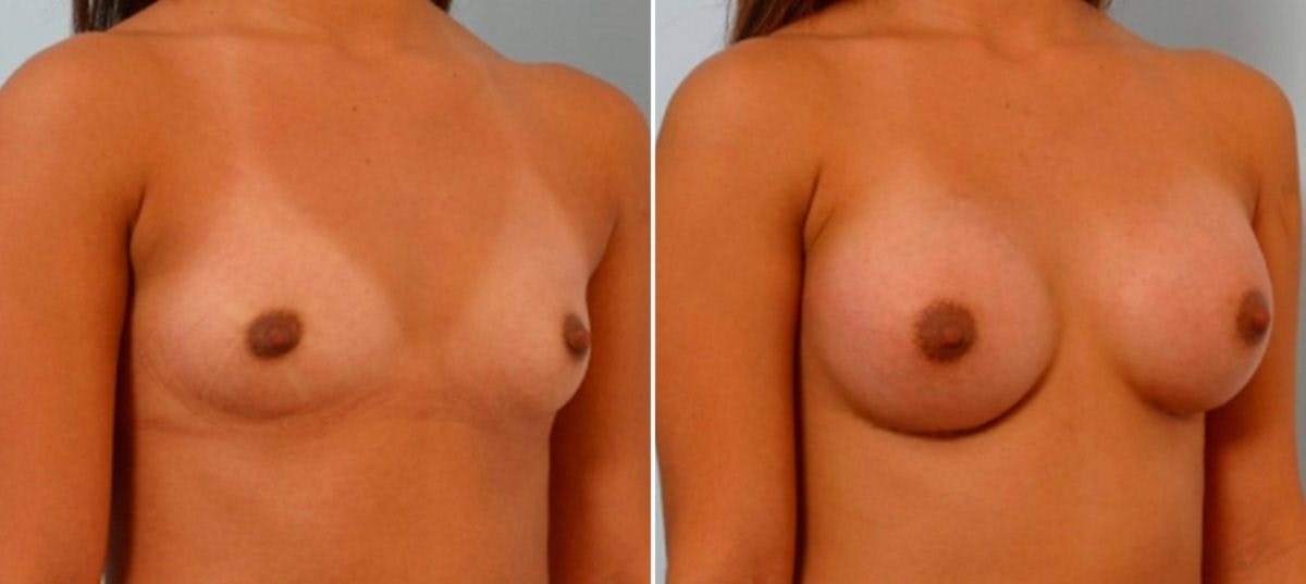Breast Augmentation Before & After Gallery - Patient 54886769 - Image 2