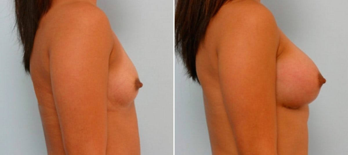 Breast Augmentation Before & After Gallery - Patient 54886769 - Image 3