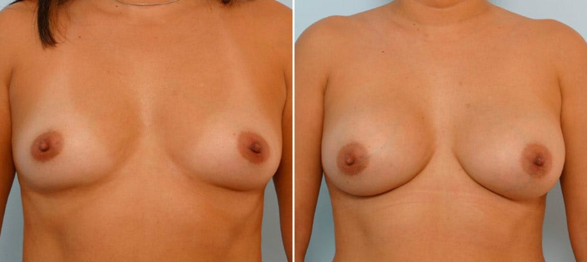 Breast Augmentation Before & After Gallery - Patient 54886774 - Image 1