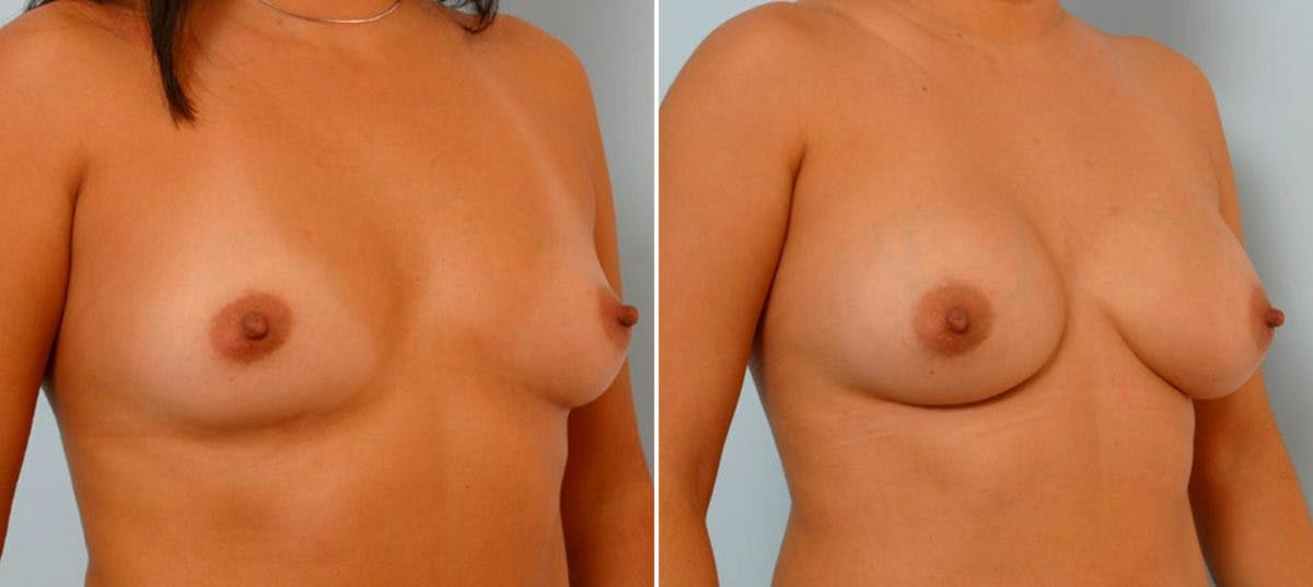 Breast Augmentation Before & After Gallery - Patient 54886774 - Image 2
