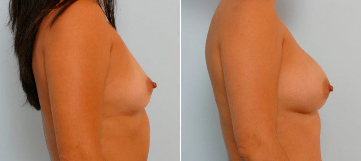 Breast Augmentation Before & After Gallery - Patient 54886774 - Image 3