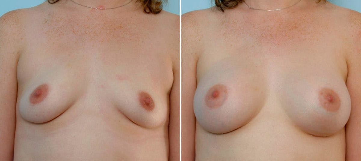 Breast Augmentation Before & After Gallery - Patient 54886777 - Image 1