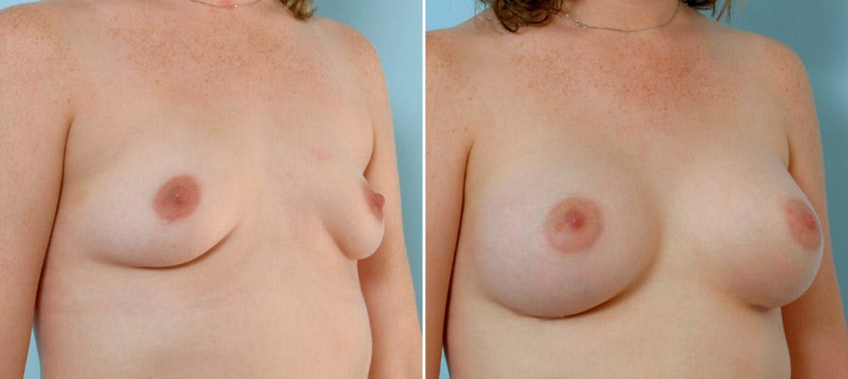 Breast Augmentation Before & After Gallery - Patient 54886777 - Image 2