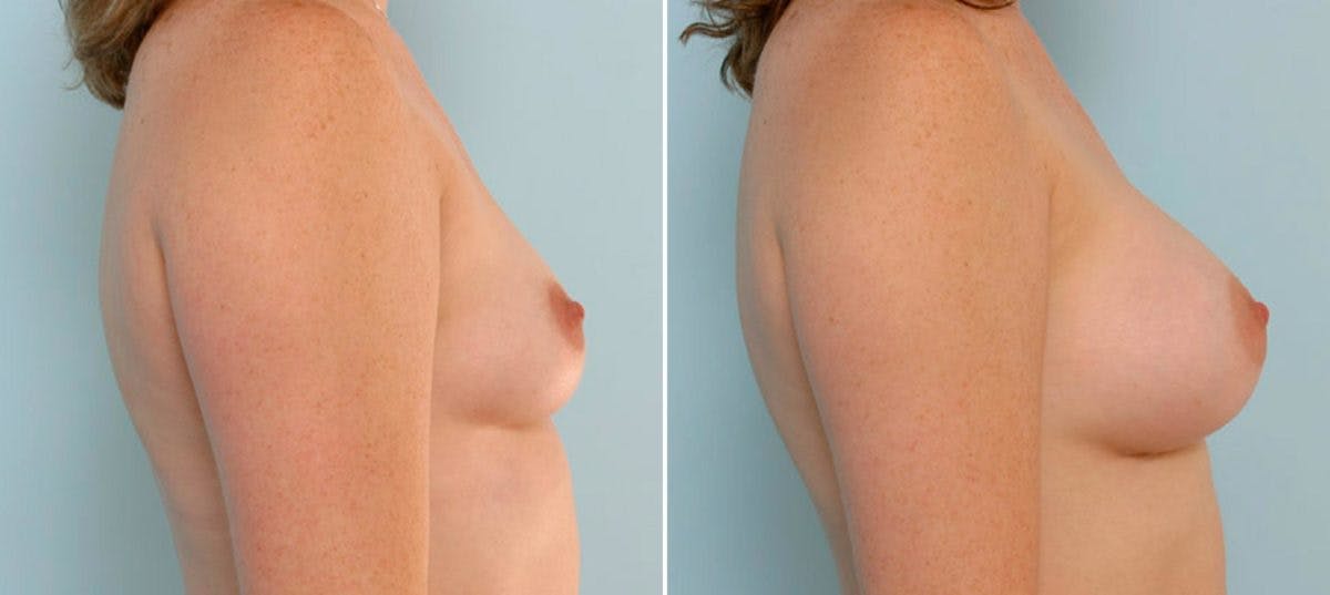 Breast Augmentation Before & After Gallery - Patient 54886777 - Image 3