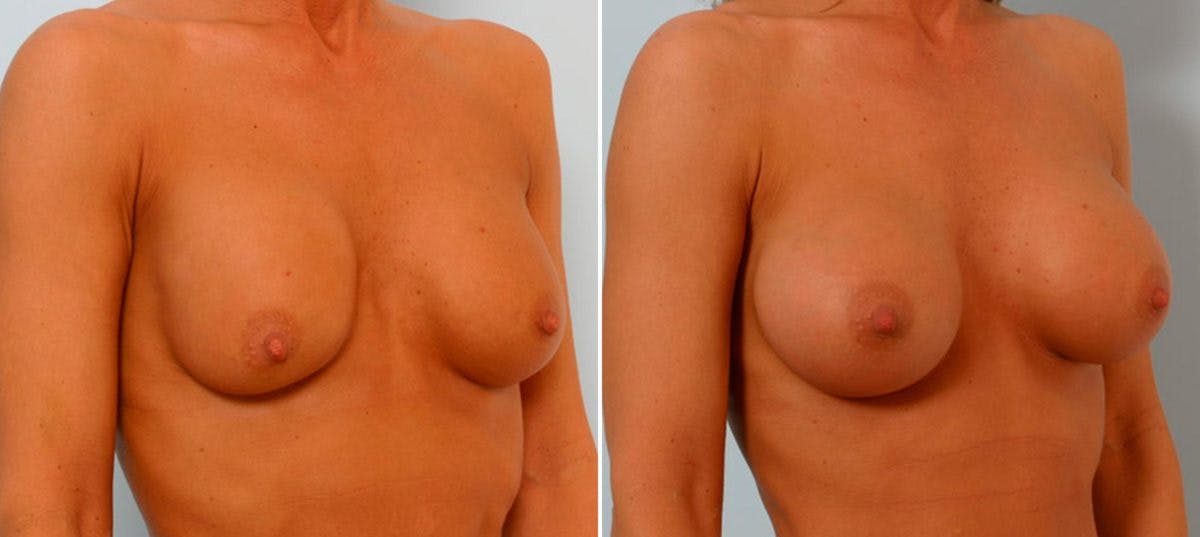 Breast Augmentation Before & After Gallery - Patient 54886778 - Image 2