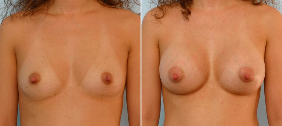 Breast Augmentation Before & After Gallery - Patient 54886779 - Image 1