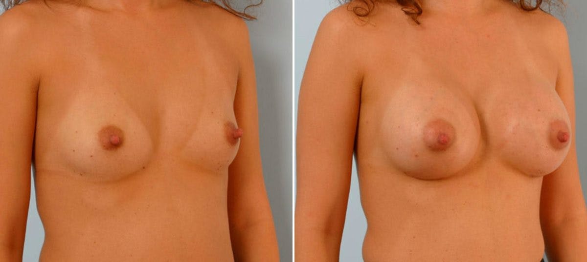 Breast Augmentation Before & After Gallery - Patient 54886779 - Image 2