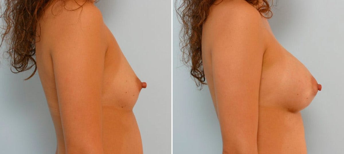 Breast Augmentation Before & After Gallery - Patient 54886779 - Image 3