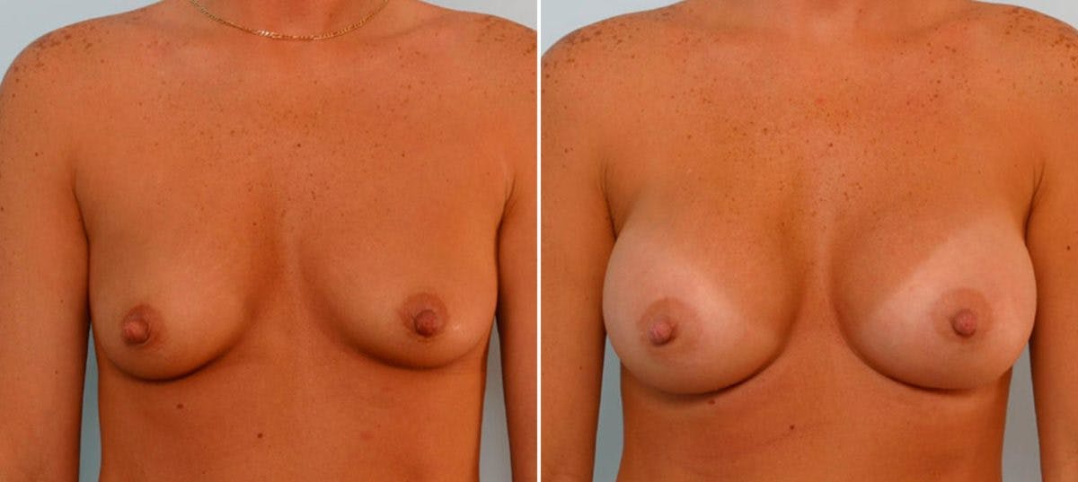 Breast Augmentation Before & After Gallery - Patient 54886782 - Image 1
