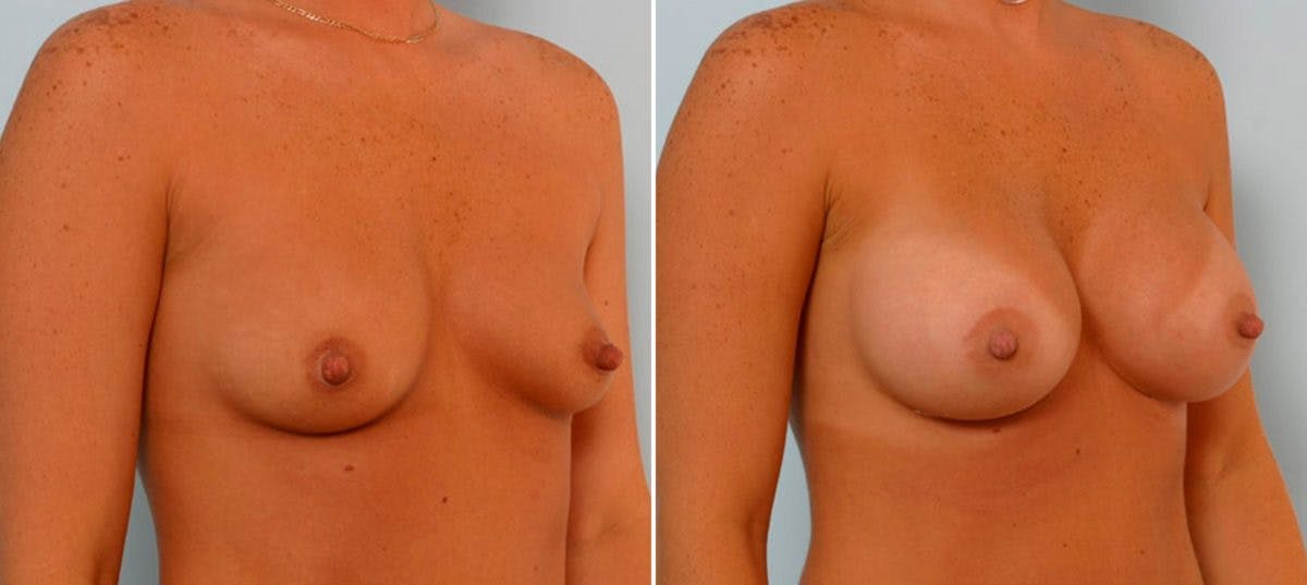 Breast Augmentation Before & After Gallery - Patient 54886782 - Image 2