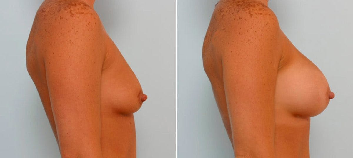 Breast Augmentation Before & After Gallery - Patient 54886782 - Image 3
