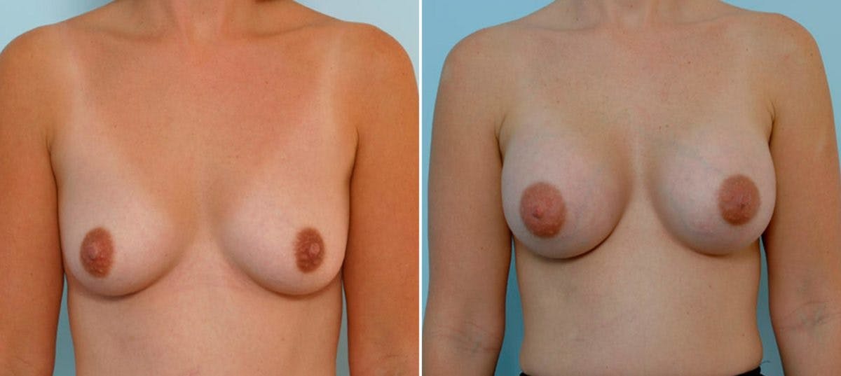 Breast Augmentation Before & After Gallery - Patient 54886783 - Image 1