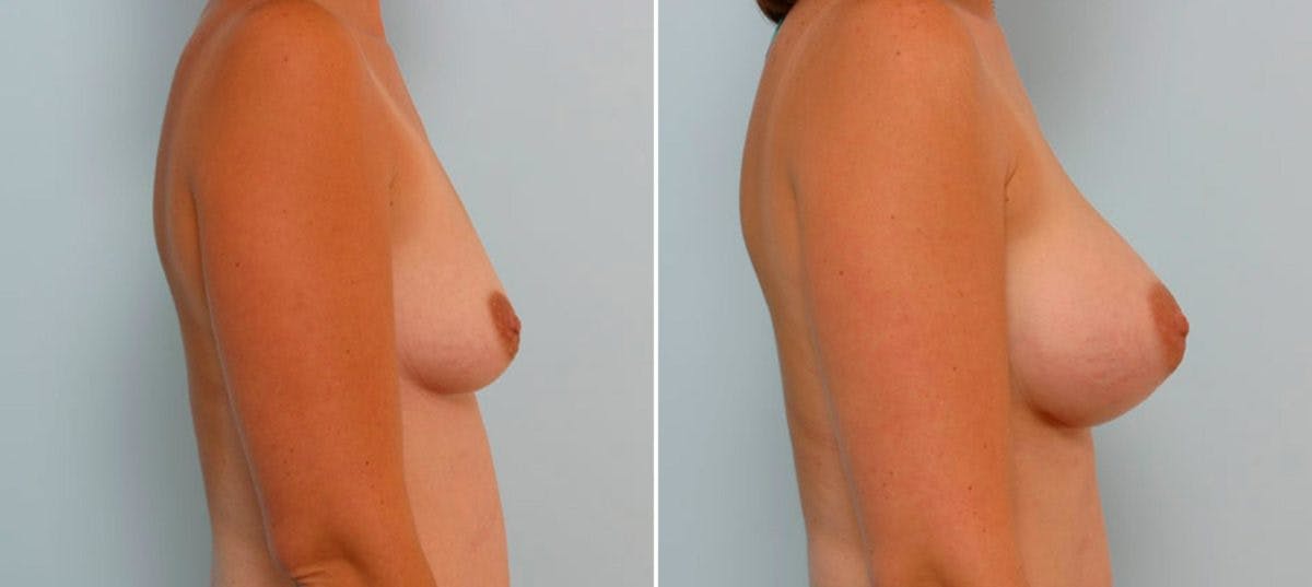 Breast Augmentation Before & After Gallery - Patient 54886783 - Image 3
