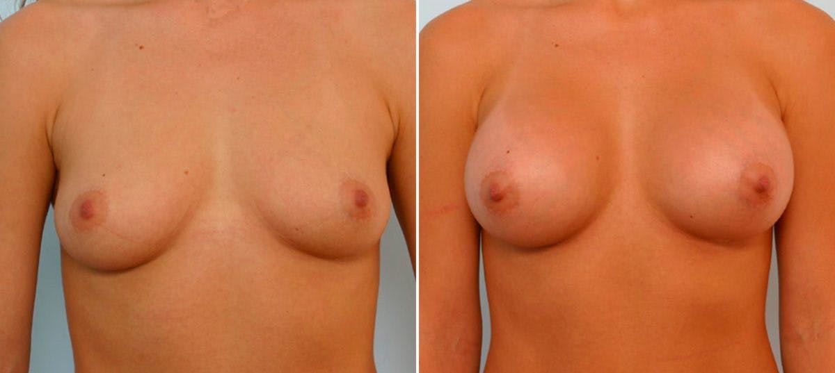 Breast Augmentation Before & After Gallery - Patient 54886786 - Image 1