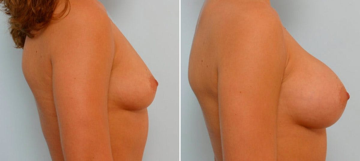 Breast Augmentation Before & After Gallery - Patient 54886786 - Image 3
