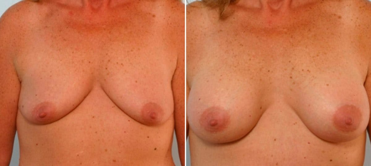 Breast Augmentation Before & After Gallery - Patient 54886787 - Image 1