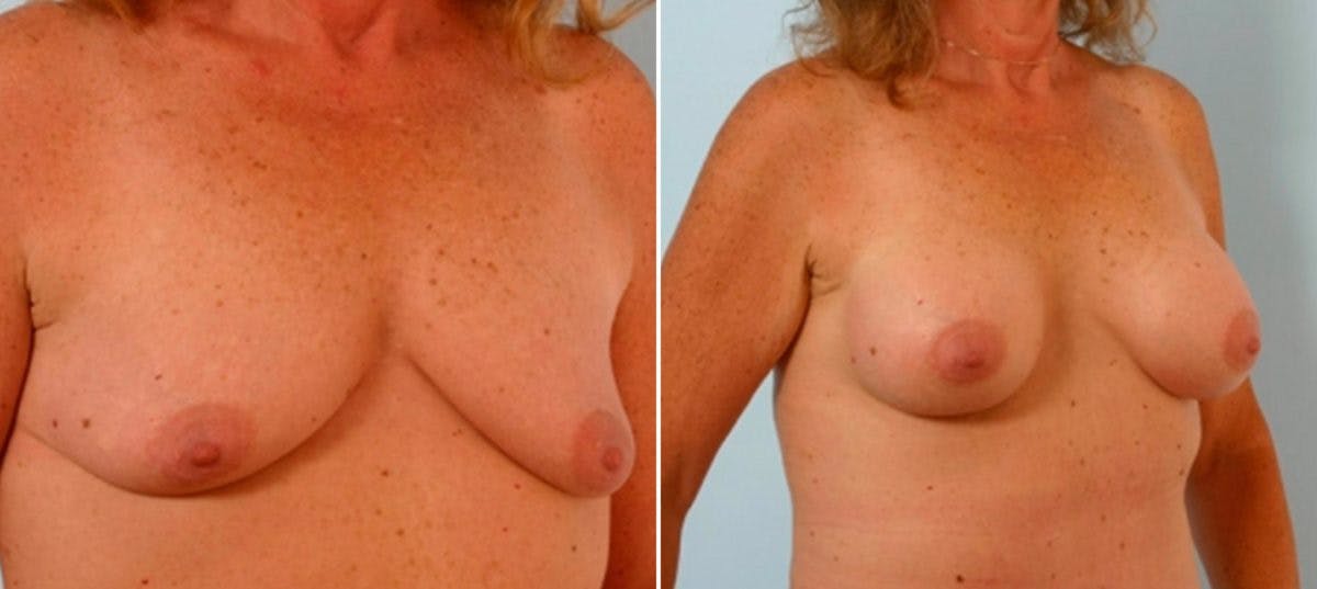Breast Augmentation Before & After Gallery - Patient 54886787 - Image 2