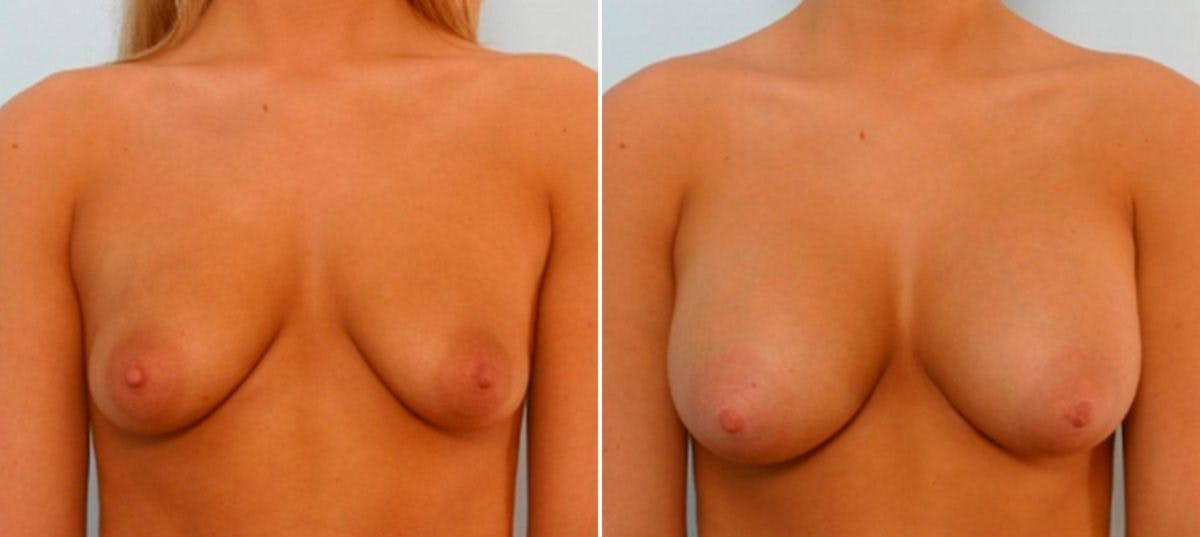 Breast Augmentation Before & After Gallery - Patient 54886789 - Image 1