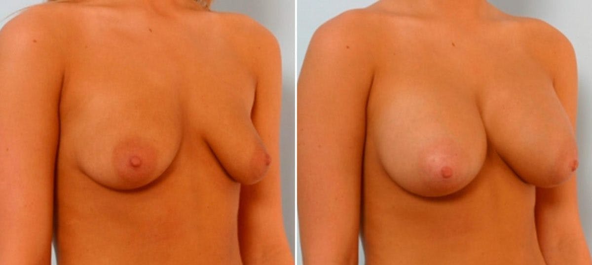 Breast Augmentation Before & After Gallery - Patient 54886789 - Image 2