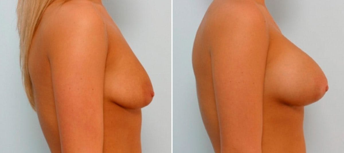 Breast Augmentation Before & After Gallery - Patient 54886789 - Image 3