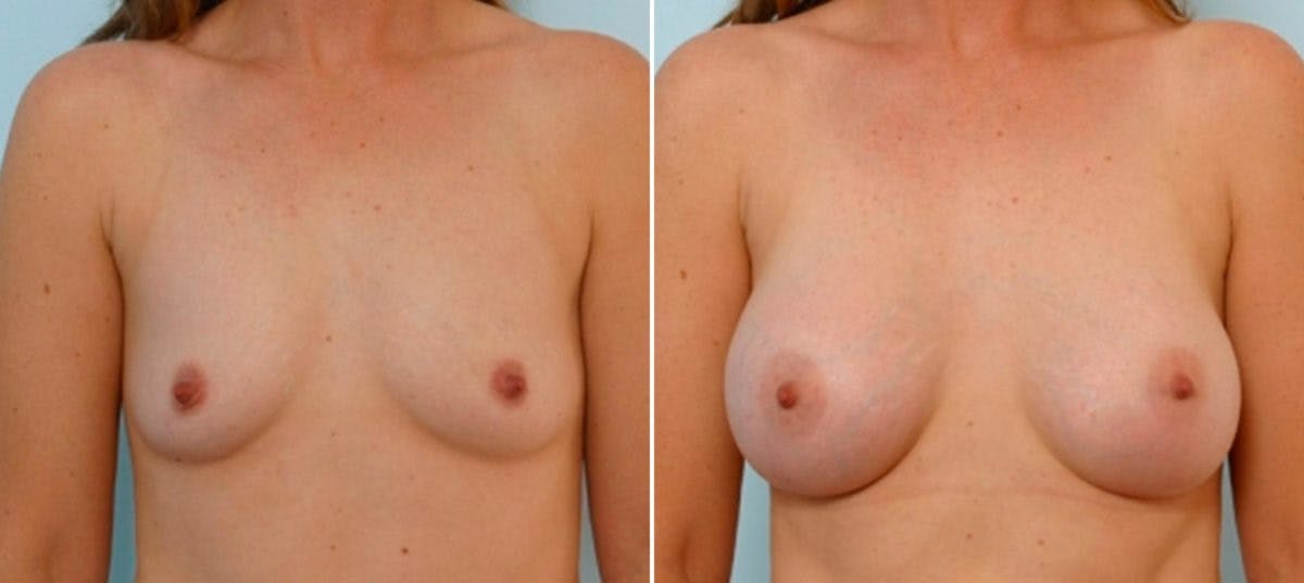 Breast Augmentation Before & After Gallery - Patient 54886792 - Image 1