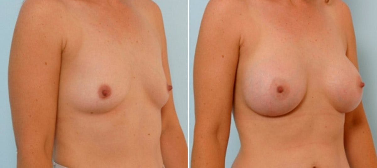 Breast Augmentation Before & After Gallery - Patient 54886792 - Image 2