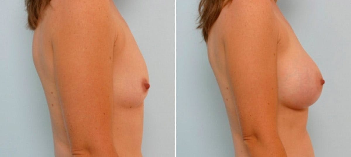 Breast Augmentation Before & After Gallery - Patient 54886792 - Image 3