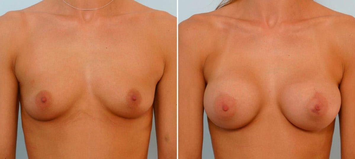 Breast Augmentation Before & After Gallery - Patient 54886794 - Image 1