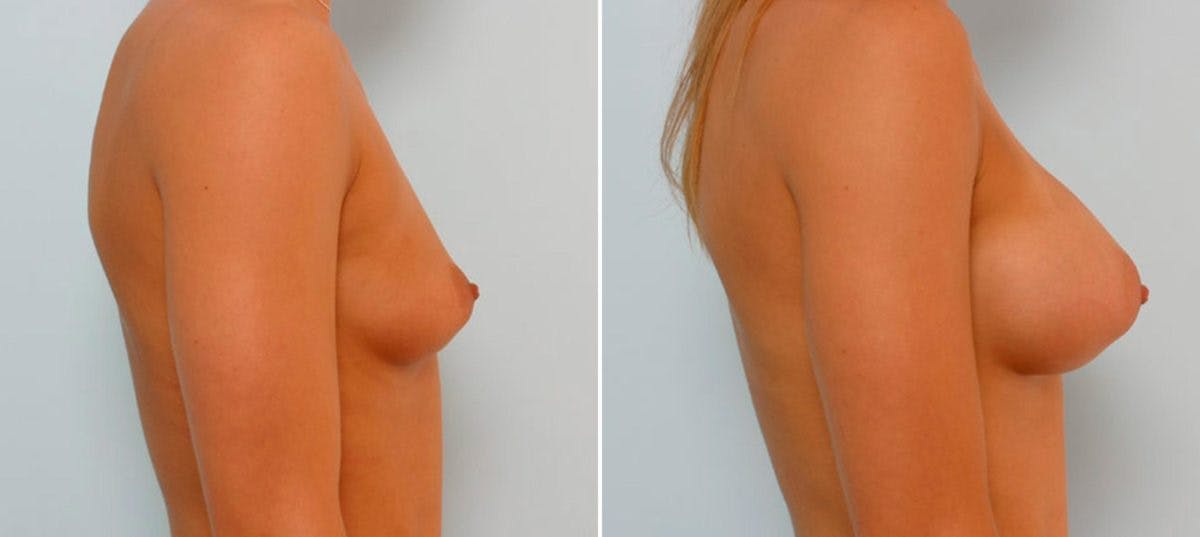 Breast Augmentation Before & After Gallery - Patient 54886794 - Image 3