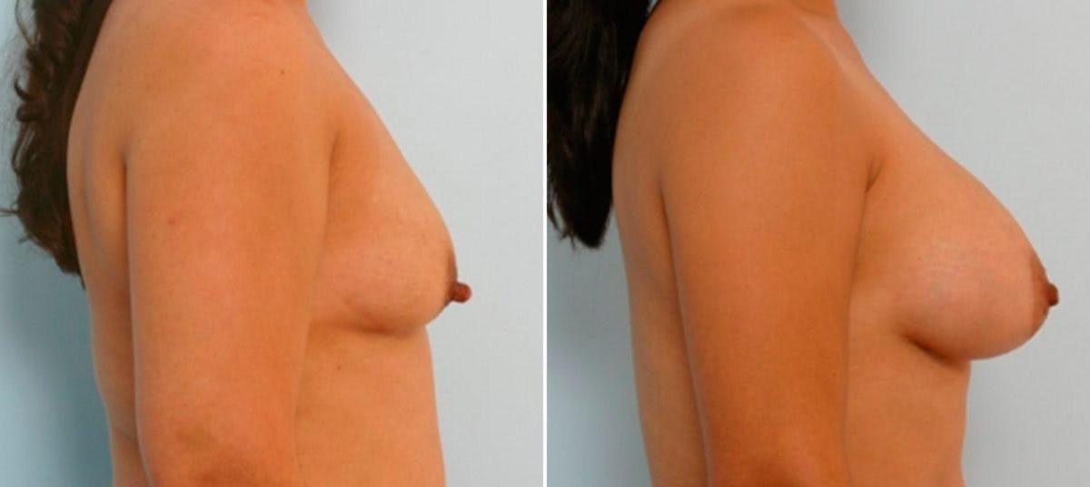 Breast Augmentation Before & After Gallery - Patient 54886795 - Image 3