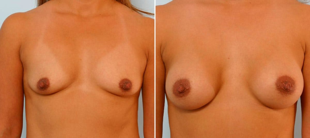 Breast Augmentation Before & After Gallery - Patient 54886798 - Image 1