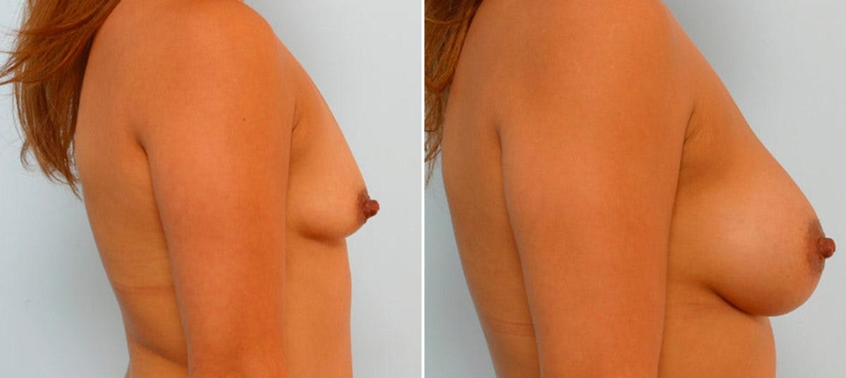 Breast Augmentation Before & After Gallery - Patient 54886798 - Image 3