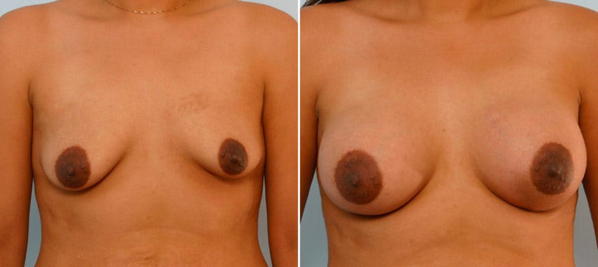 Breast Augmentation Before & After Gallery - Patient 54886799 - Image 1