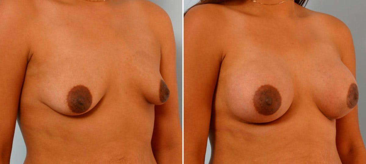 Breast Augmentation Before & After Gallery - Patient 54886799 - Image 2
