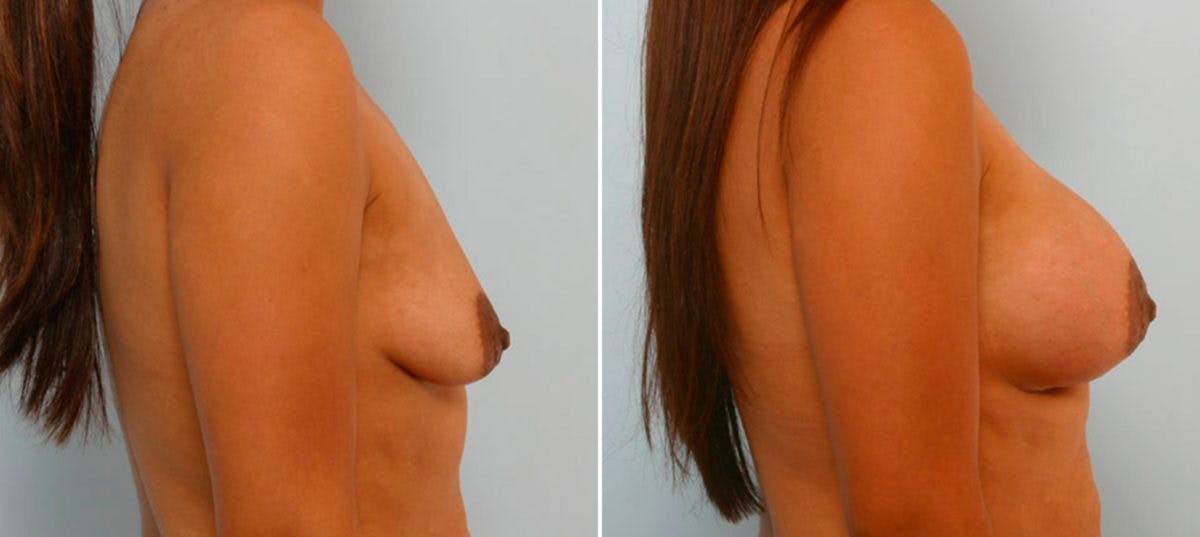Breast Augmentation Before & After Gallery - Patient 54886799 - Image 3