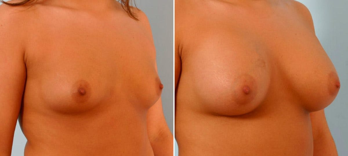 Breast Augmentation Before & After Photo - Patient 54886800 - Image 2