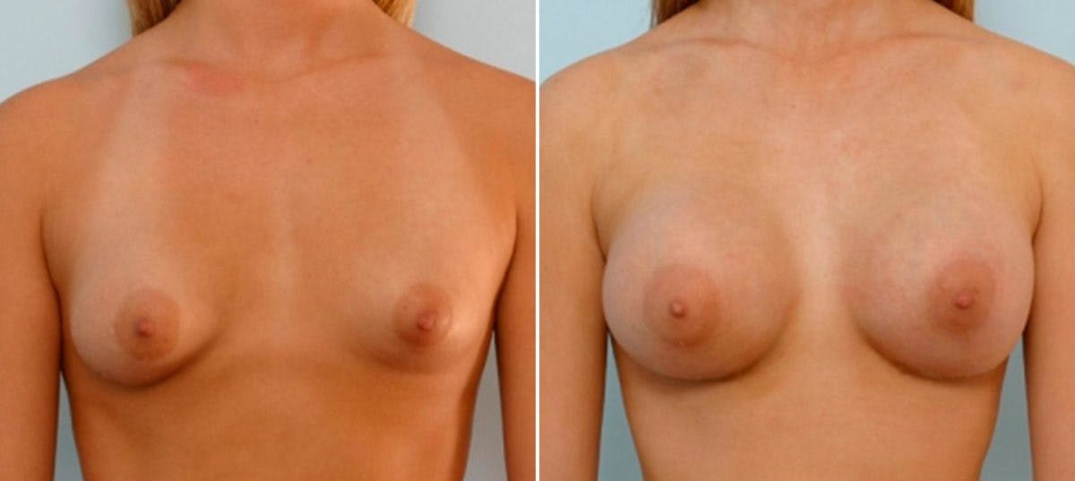 Breast Augmentation Before & After Photo - Patient 54886801 - Image 1