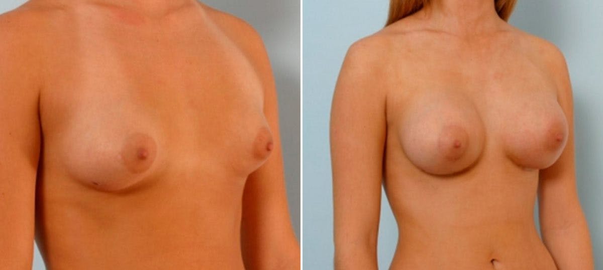 Breast Augmentation Before & After Gallery - Patient 54886801 - Image 2