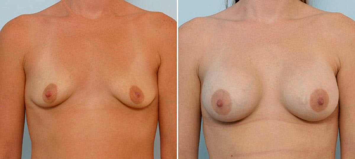 Breast Augmentation Before & After Photo - Patient 54886802 - Image 1