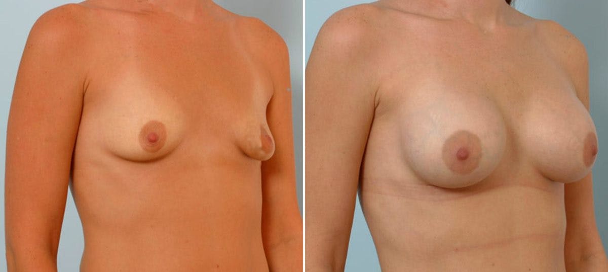Breast Augmentation Before & After Gallery - Patient 54886802 - Image 2