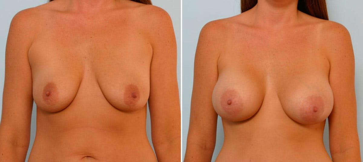Breast Augmentation Before & After Gallery - Patient 54886803 - Image 1