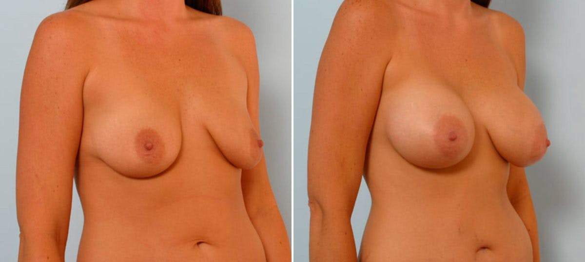 Breast Augmentation Before & After Gallery - Patient 54886803 - Image 2