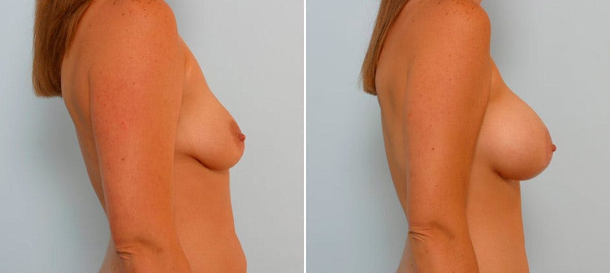 Breast Augmentation Before & After Gallery - Patient 54886803 - Image 3