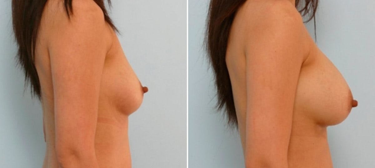 Breast Augmentation Before & After Gallery - Patient 54886805 - Image 3