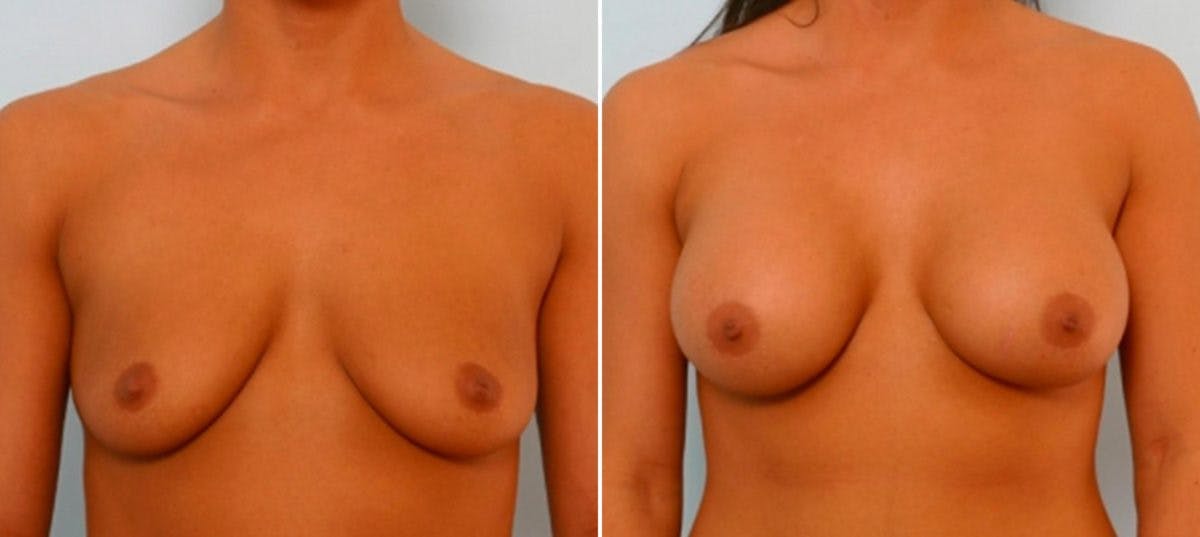 Breast Augmentation Before & After Gallery - Patient 54886807 - Image 1