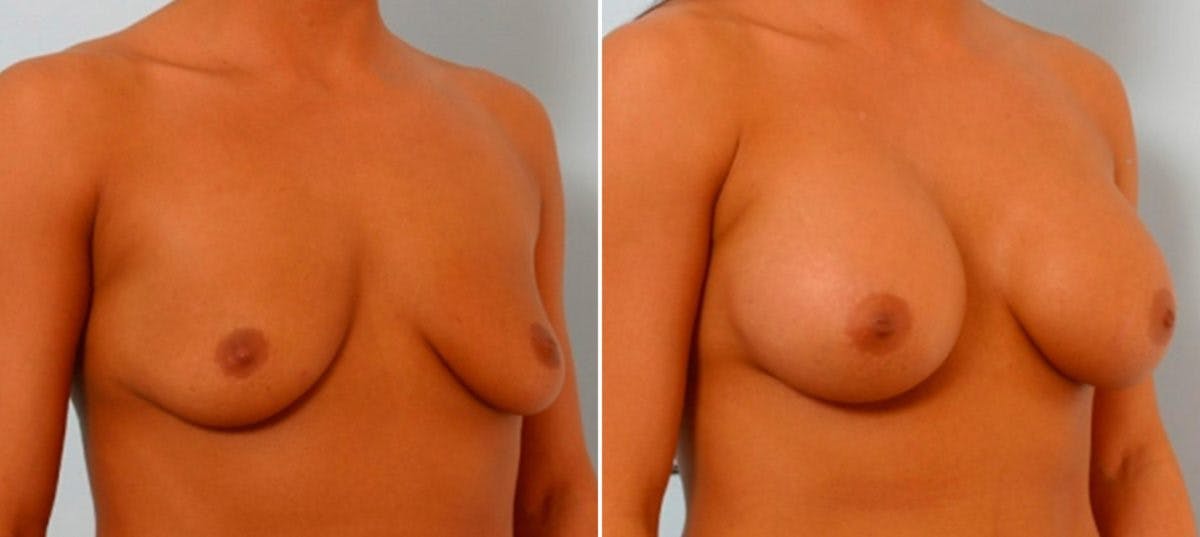 Breast Augmentation Before & After Gallery - Patient 54886807 - Image 2