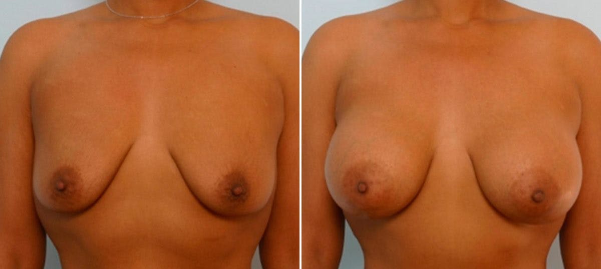 Breast Augmentation Before & After Gallery - Patient 54886808 - Image 1
