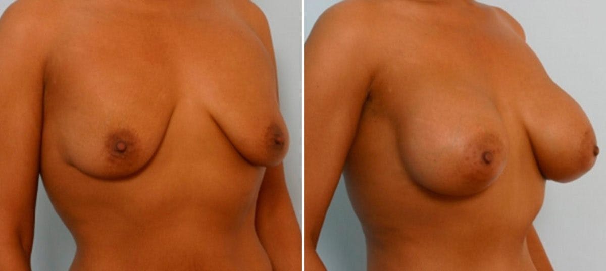 Breast Augmentation Before & After Gallery - Patient 54886808 - Image 2